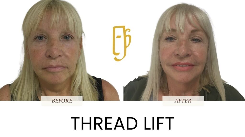 “Thread lift by Dr. Ali Soueid – medical illustration showing insertion of dissolvable threads to lift sagging skin in the mid-face, jawline, and neck without surgery in London, Dubai, Doha, and Beirut.”