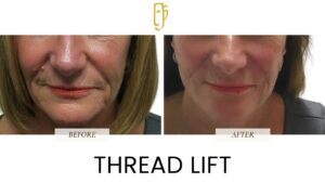 “Thread lift by Dr. Ali Soueid – medical illustration showing insertion of dissolvable threads to lift sagging skin in the mid-face, jawline, and neck without surgery in London, Dubai, Doha, and Beirut.”