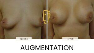 “Breast augmentation surgery by Dr. Ali Soueid – diagram showing implant placement to enhance breast shape, size, and symmetry in London, Dubai, Doha, and Beirut.”