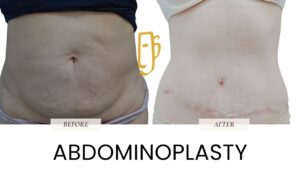 “Before and after tummy tuck (abdominoplasty) by Dr. Ali Soueid – visible improvement in abdominal contour, excess skin removal, and muscle tightening in London, Dubai, Doha, and Beirut.”