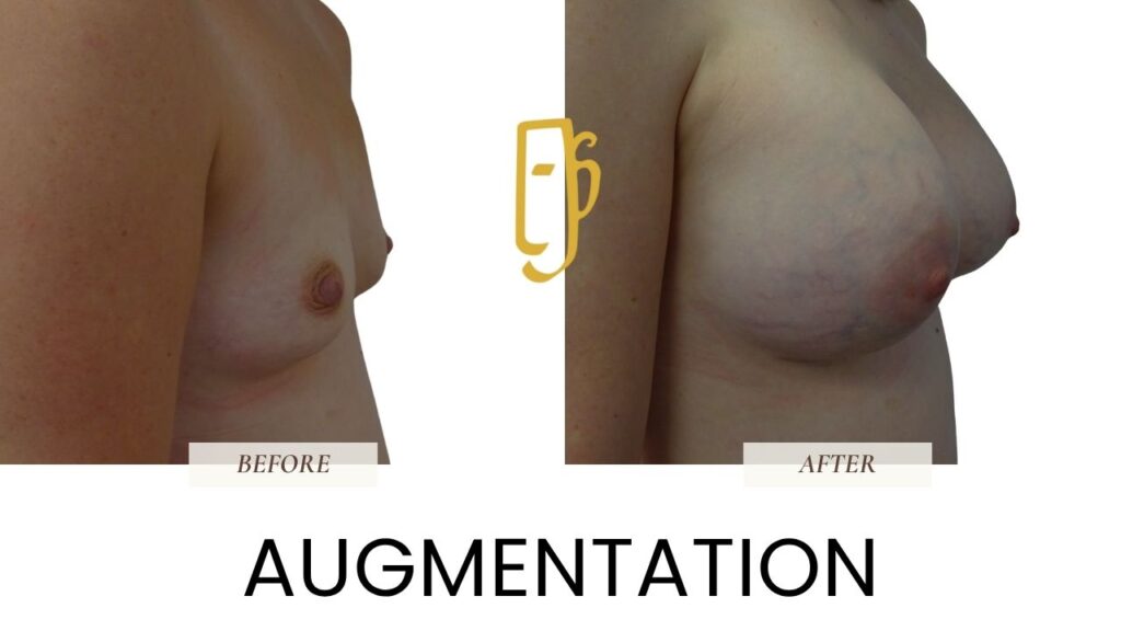 “Breast augmentation surgery by Dr. Ali Soueid – diagram showing implant placement to enhance breast shape, size, and symmetry in London, Dubai, Doha, and Beirut.”