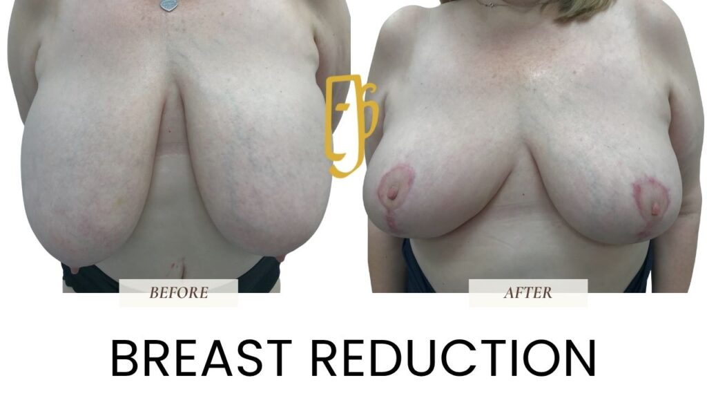 “Breast reduction surgery by Dr. Ali Soueid – diagram showing removal of excess breast tissue and skin to relieve discomfort and achieve smaller, balanced breast shape in London, Dubai, Doha, and Beirut.”