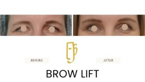 Brow lift