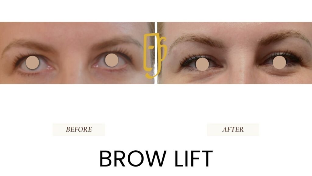 “Brow lift surgery by Dr. Ali Soueid – illustration of forehead lift procedure to elevate eyebrows, smooth frown lines, and rejuvenate the upper face in Dubai and London.”
