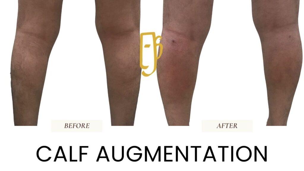 “Fat grafting by Dr. Ali Soueid – diagram showing liposuction and reinjection of purified fat to enhance volume in the face, breasts, or body in London, Dubai, Doha, and Beirut.”