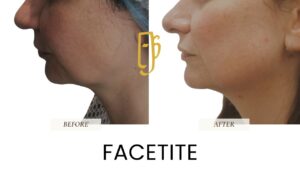 “Morpheus8 treatment by Dr. Ali Soueid – illustration showing microneedling with radiofrequency technology to tighten skin and contour face or body in London, Dubai, Doha, and Beirut.”