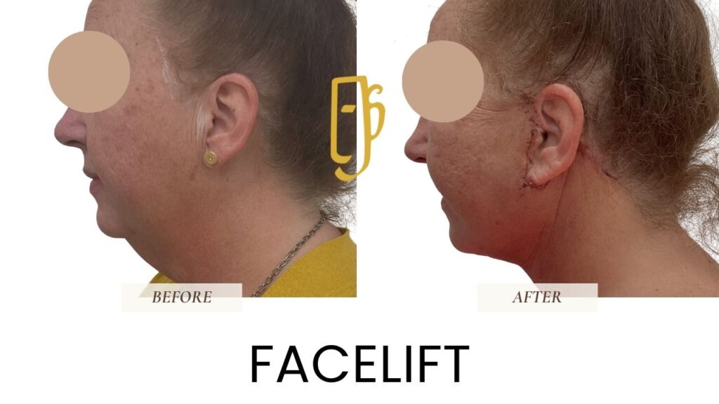 “Facelift surgery by Dr. Ali Soueid – illustration showing SMAS layer lifting and skin tightening to restore youthful facial contours in London, Dubai, and Doha.”