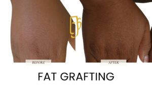 “Fat grafting by Dr. Ali Soueid – diagram showing liposuction and reinjection of purified fat to enhance volume in the face, breasts, or body in London, Dubai, Doha, and Beirut.”