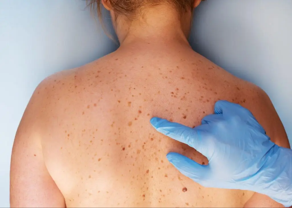 Minor Surgery 5 A close-up image of a mole on the skin being examined with a dermatoscope during a skin cancer screening.