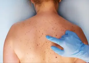 A close-up image of a mole on the skin being examined with a dermatoscope during a skin cancer screening.