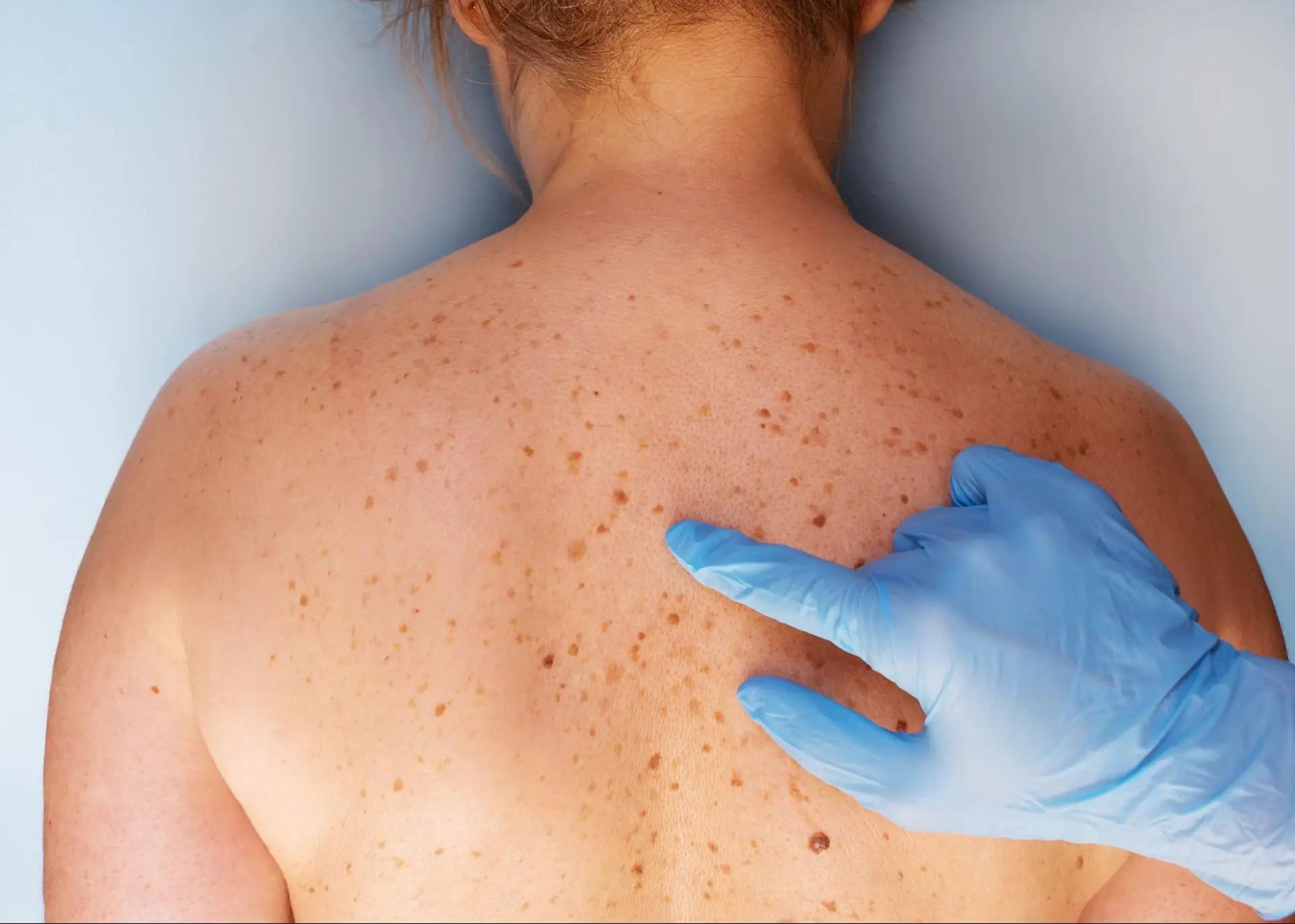 A close-up image of a mole on the skin being examined with a dermatoscope during a skin cancer screening.