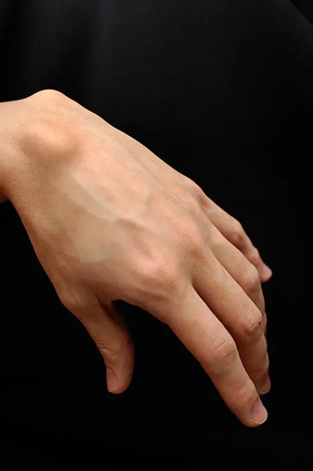 Ganglion cyst on the back of the wrist in a middle-aged patient