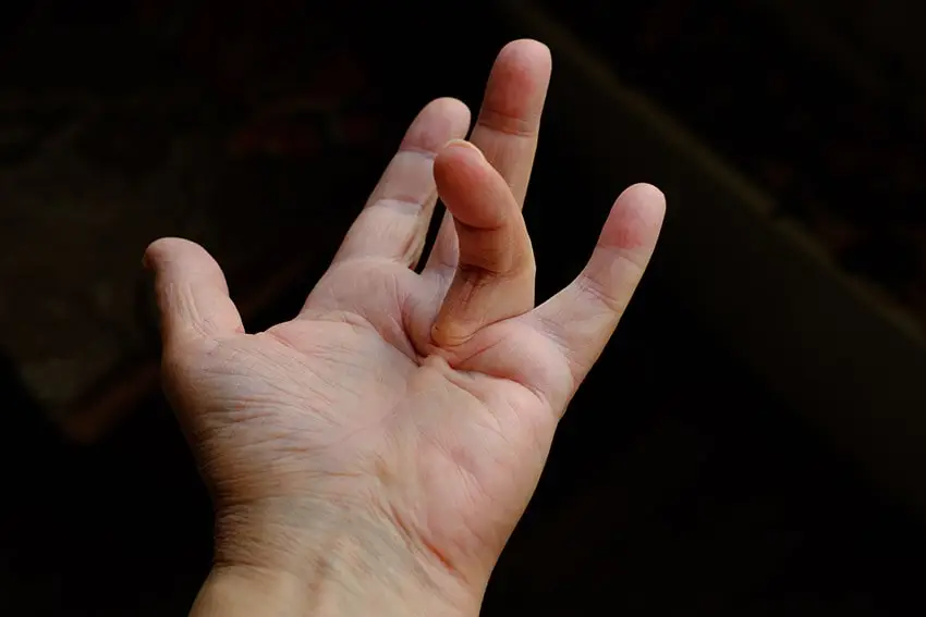 Hand showing Dupuytren’s contracture with flexed ring and little fingers
