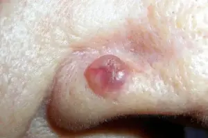 Illustration of basal cell carcinoma (BCC) showing a pearly, slow-growing skin lesion on the face with features commonly seen in early skin cancer.