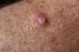 Illustration of squamous cell carcinoma (SCC) showing a scaly, crusted skin lesion with ulceration, typical features of this common form of skin cancer.