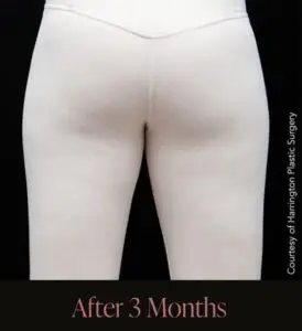 After Aveli® cellulite treatment showing smoother-looking skin and reduced cellulite dimples on the buttocks and thighs, following treatment by Dr. Ali Soueid in Doha, Qatar.
