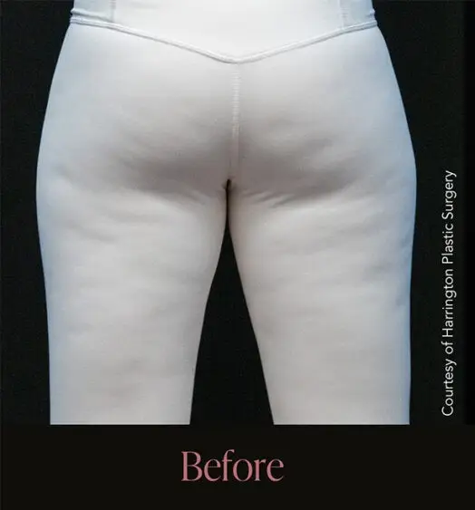 Aveli® cellulite treatment in Doha, Qatar, targeting cellulite dimples on the buttocks and thighs with Dr. Ali Soueid.